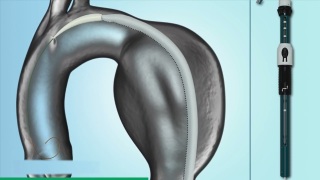 RelayPro Non Bare Stent   Deployment Animation HD   Global